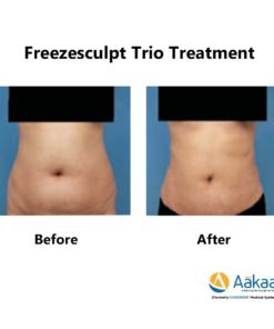 Freezescuplt-Cryolipolysis-2