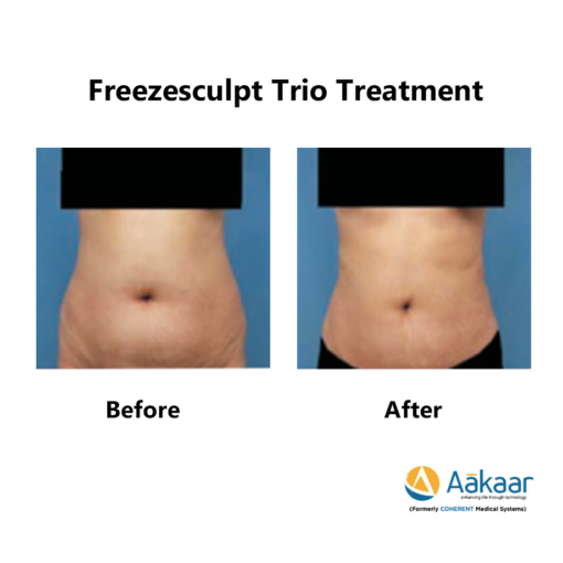 Freezescuplt-Cryolipolysis-2