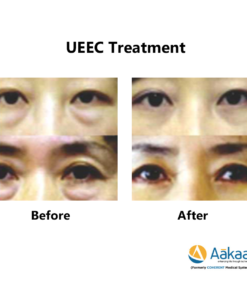 UEEC-Under-eye-2