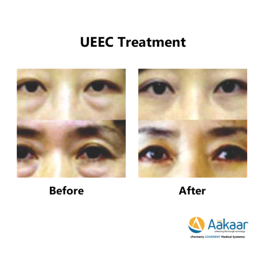 UEEC-Under-eye-2