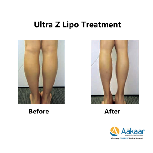 Z-lipo-HI-Definition-Liposuction